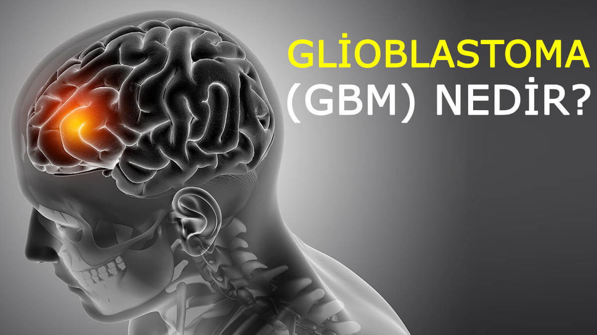 Glioblastoma (GBM) nedir?
